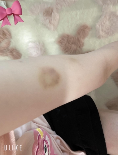 愛おしい激痛噛み跡。。💕画像１